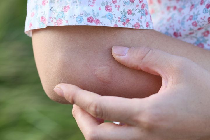 What you need to know about bug bites this summer